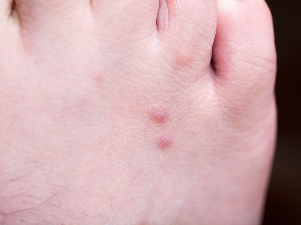 How To Tell If You Have Fleas